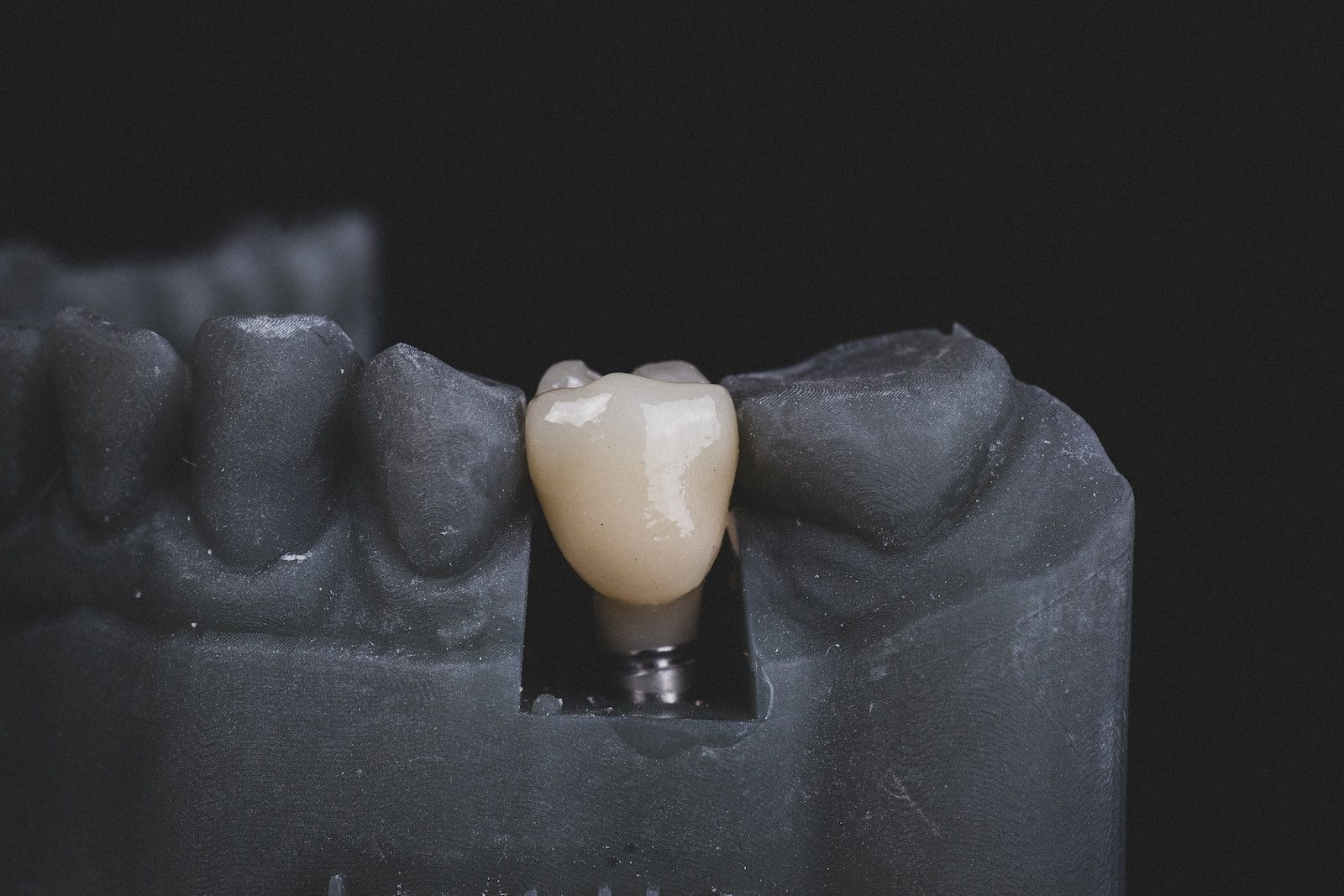 Dental Implant Services