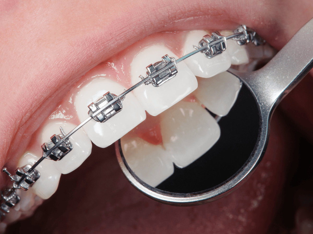 7 Helpful Tips for Choosing Braces or Aligners