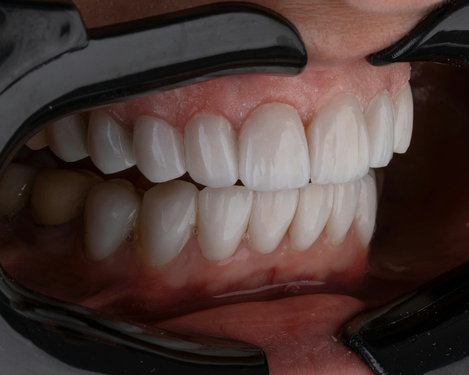 Teeth Whitening in Vijayawada - Krishna Dental