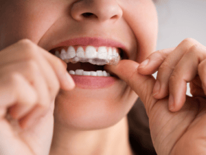 Aligners vs Braces