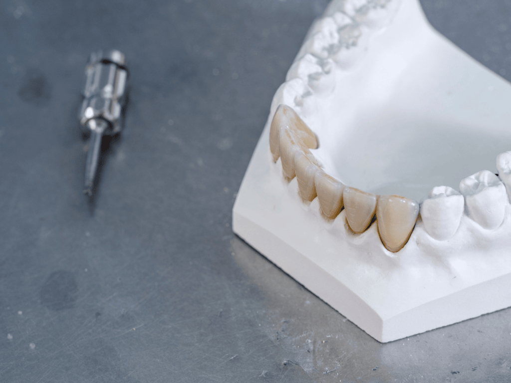 5 Key Factors for Choosing the Best Dental Implant 