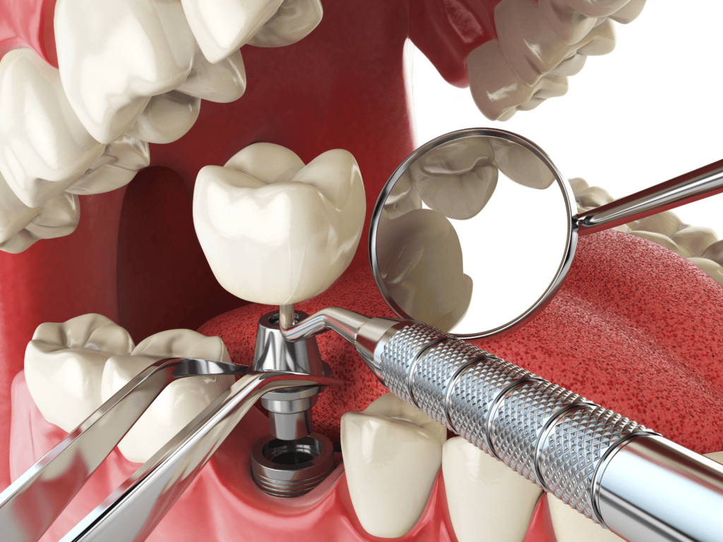 5 Key Factors for Choosing the Best Dental Implant