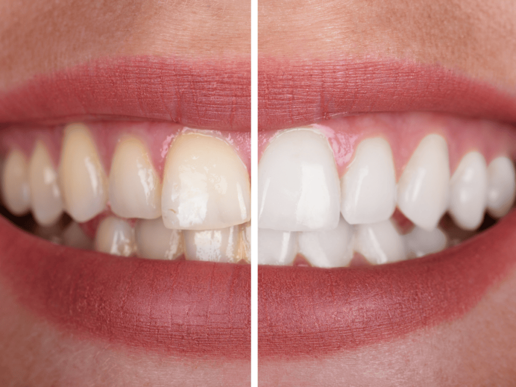 Teeth Whitening: Causes of Stains and How Krishna Dental Can Help