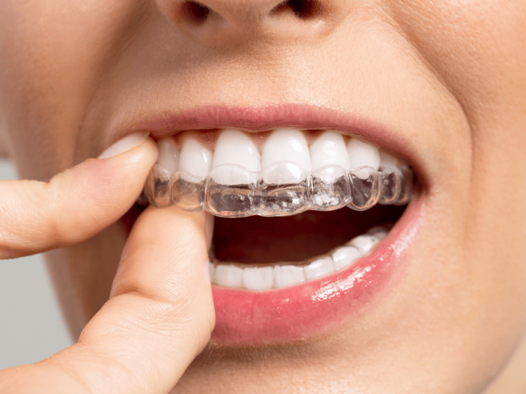 Aligners vs Braces: What You Need to Know Before Starting Treatment