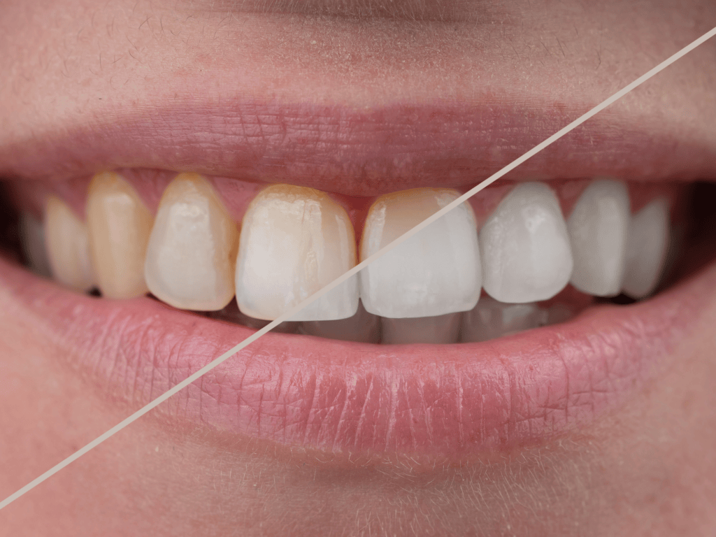 Teeth Whitening: Brighten Your Smile with Krishna Dental