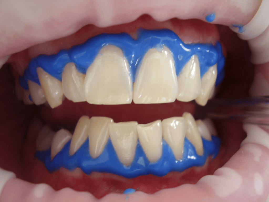 Teeth Whitening: Brighten Your Smile with Krishna Dental