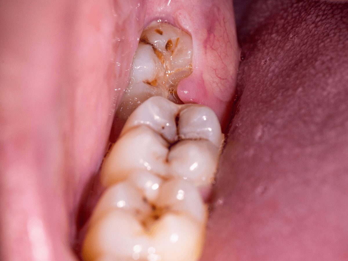 Does Wisdom Tooth Need Removal? Expert Insights from Krishna Dental
