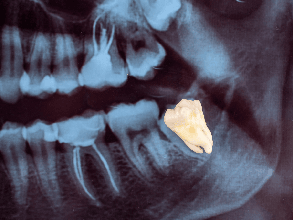 Does Wisdom Tooth Need Removal? Expert Insights from Krishna Dental