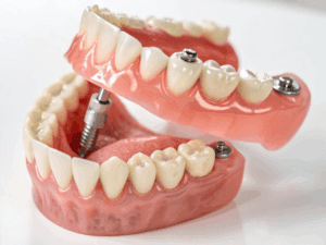 dentures types