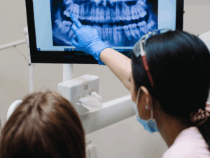 Tooth Decay X Ray