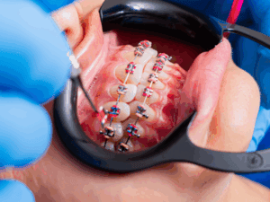 Different Types of Braces