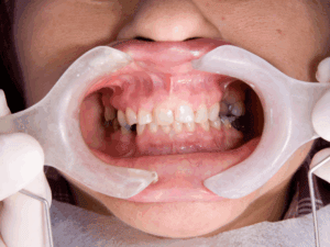 Full Mouth Rehabilitation