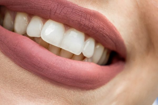 Teeth Whitening in Vijayawada - Krishna Dental