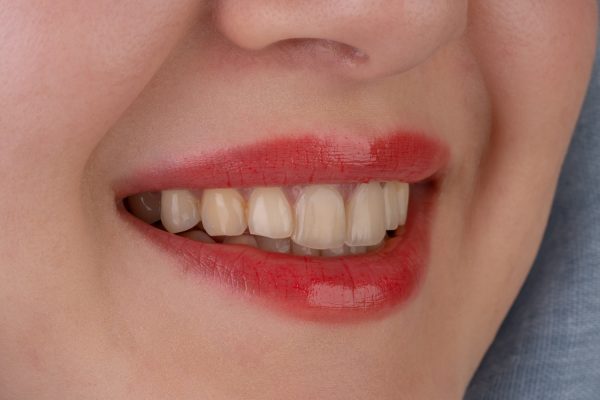 Cosmetic Dental Surgeries